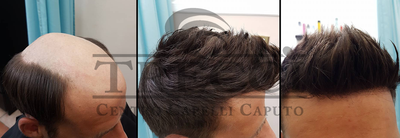 protesi capelli uomo napoli