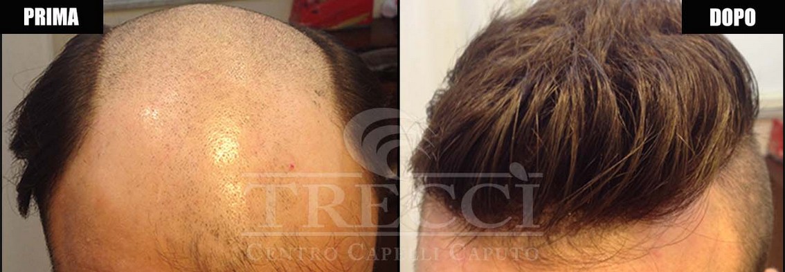 impianti capelli