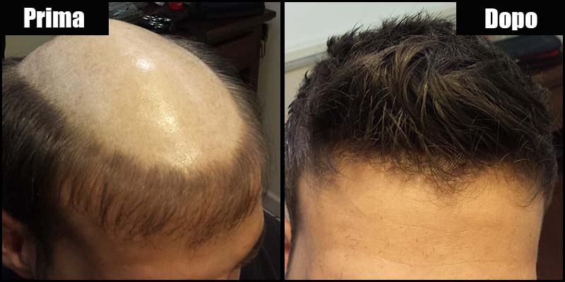 protesi capelli